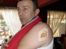 Dejan Milenković pokazuje povrede (Foto: Blic)