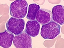Djevojčica izliječena od leukemije pomoću HIV-a