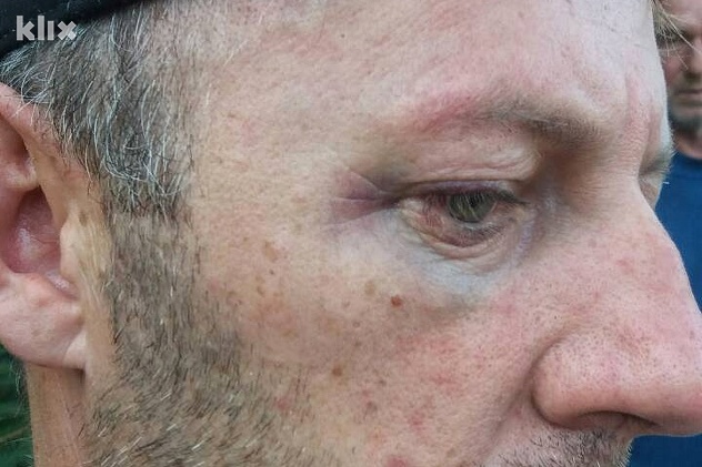 Podlivi ispod očiju (Foto: Klix.ba)