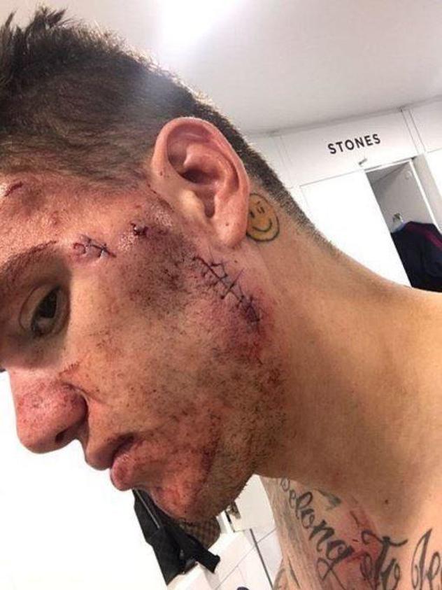 Ederson je ovu fotografiju napravio nakon šivanja