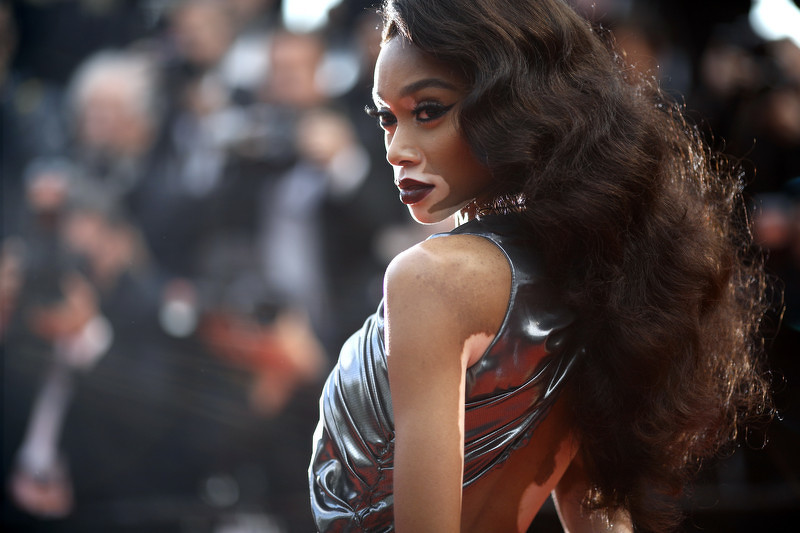 Winnie Harlow (Foto: EPA-EFE)