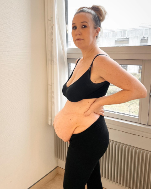 Michellin stomak nakon što se porodila