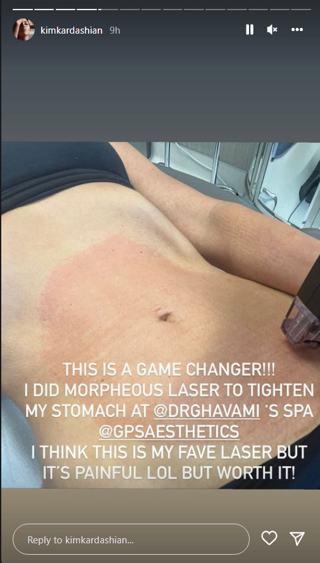 Kim se podvrgnula zahvatu zatezanja stomaka (Foto: Instagram)