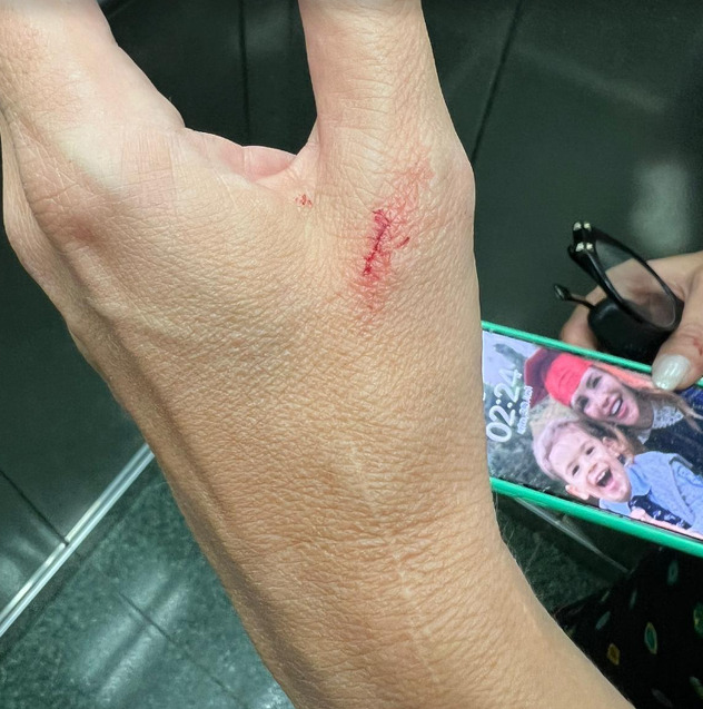 Ozlijede na Severininim rukama