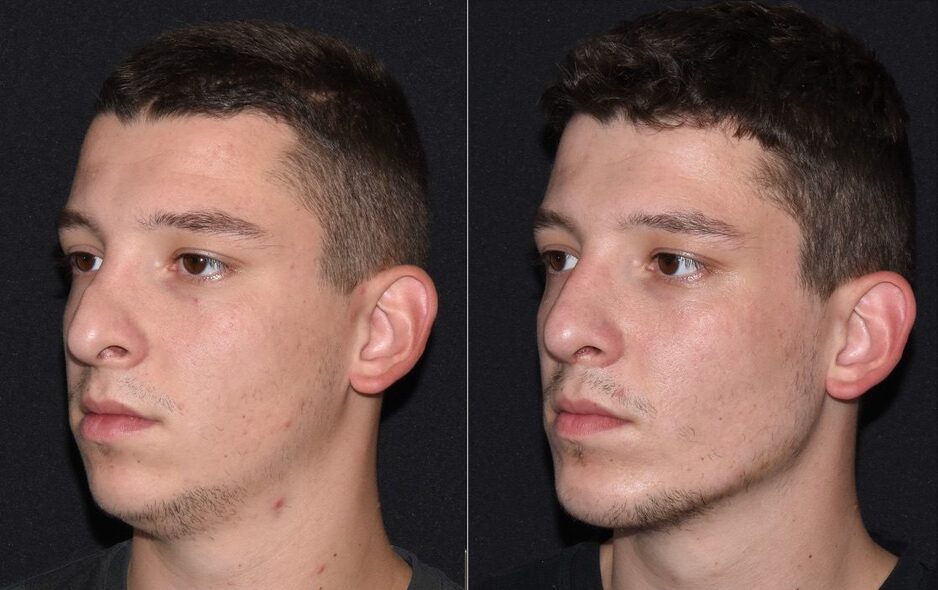 Rinoplastika