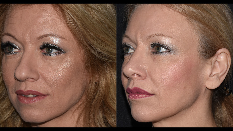 Rinoplastika