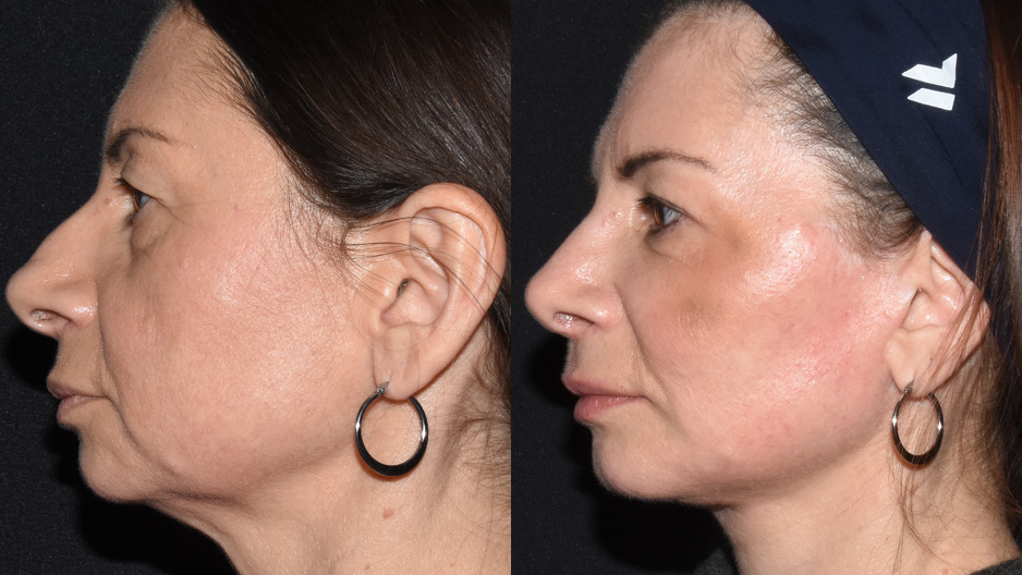 Rinoplastika
