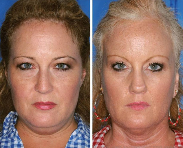 Foto: American Society of Plastic Surgeons