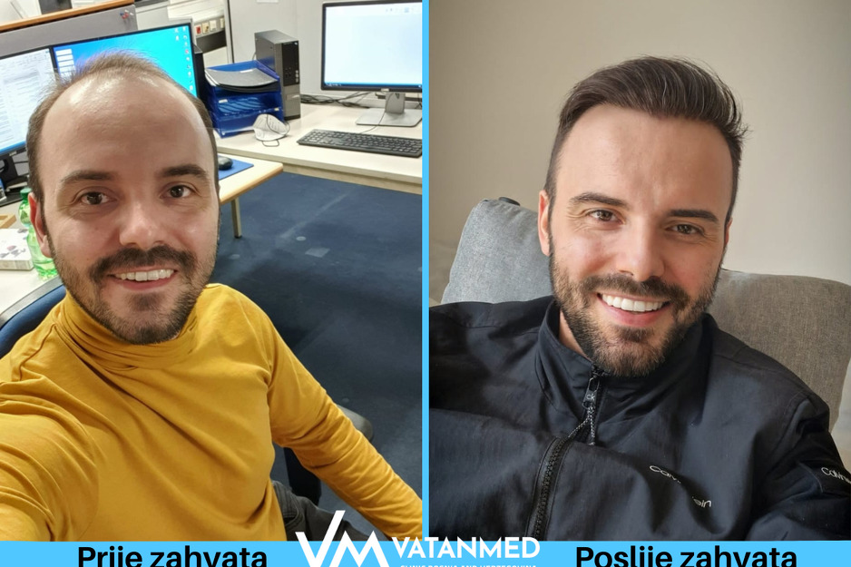 Prije i poslije zahvata