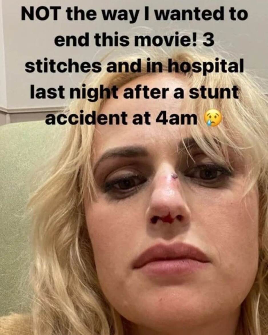 Povreda na licu Rebel Wilson