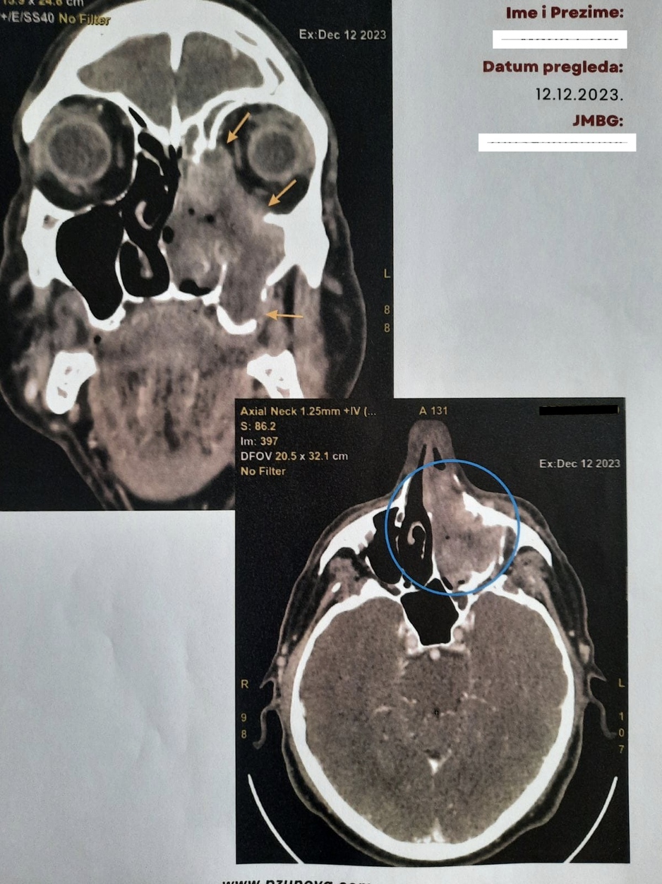 CT glave s karcinom koji je zahvatio lijevu polovinu lica uz destrukciju koštanih struktura