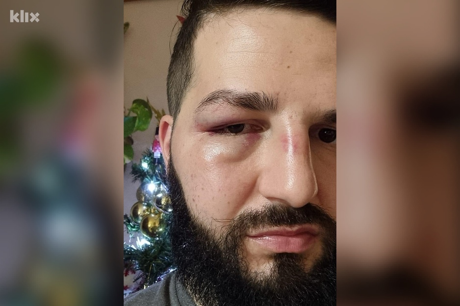 Mirza Dervišević nakon napada (Foto: Facebook)