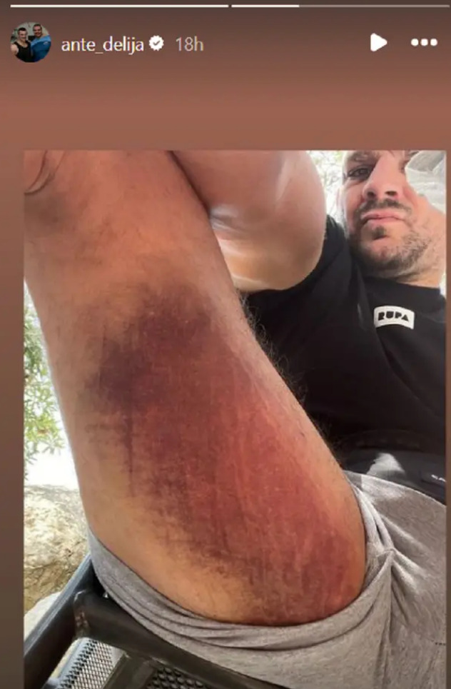 Delija pokazao povredu noge (Foto: Instagram)