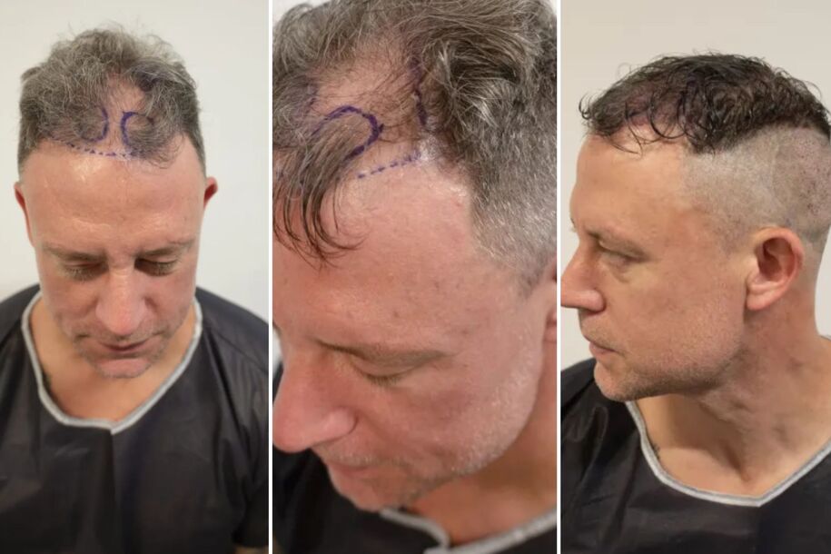 Bridge prije i poslije presađivanja kose (Foto: The Sun)