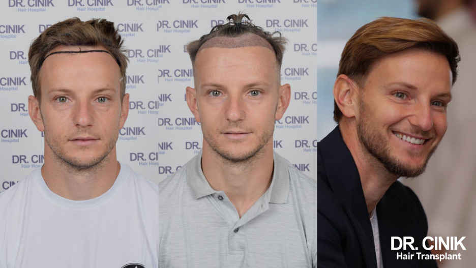 Ivan Rakitić presadio kosu (Foto: emrahcinik.com)