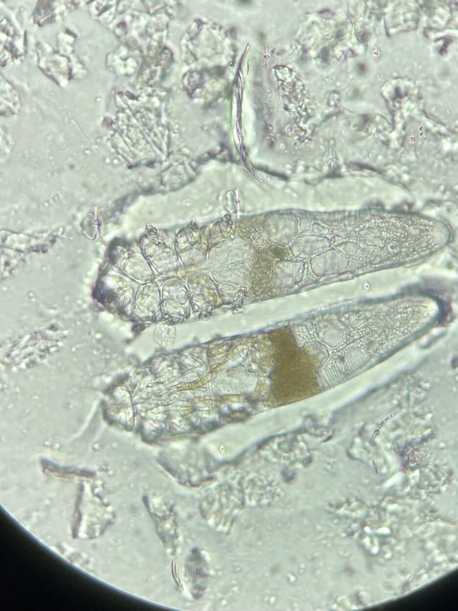 Demodex Folliculorum