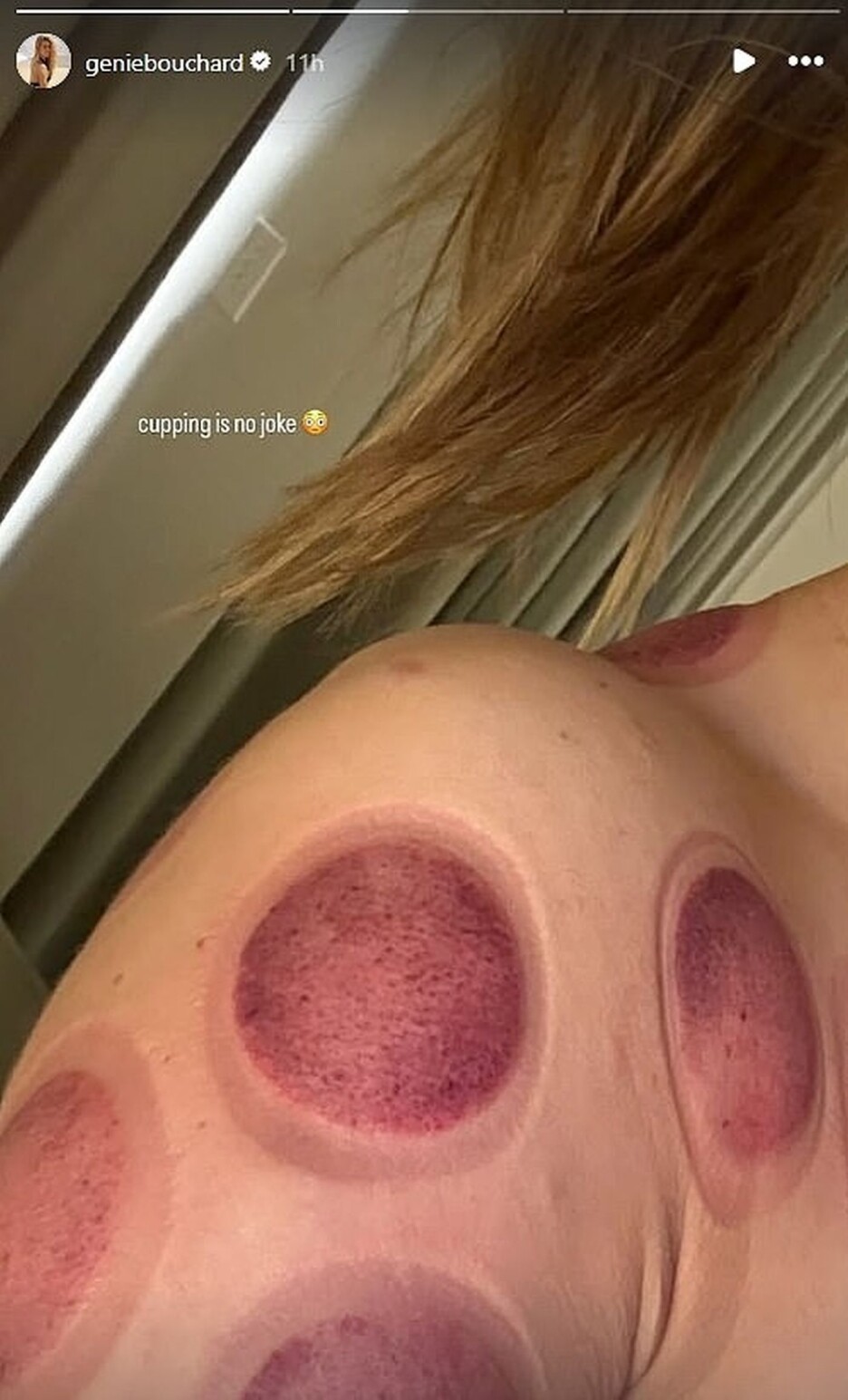 Eugenie Bouchard pokazala ožiljke nakon hidžame (Foto: Instagram)