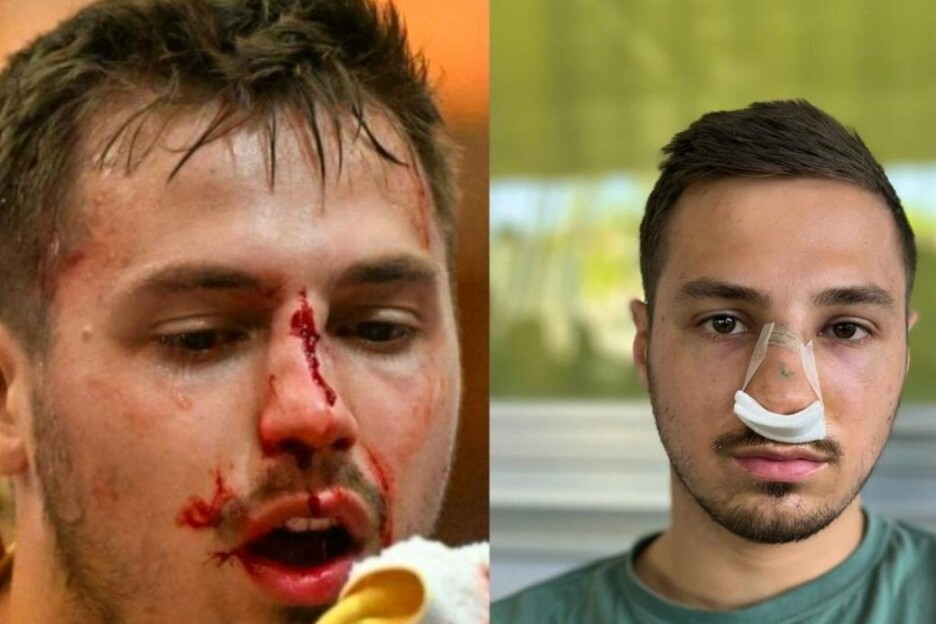 Horor povreda u austrijskom rukometu (Foto: Twitter)
