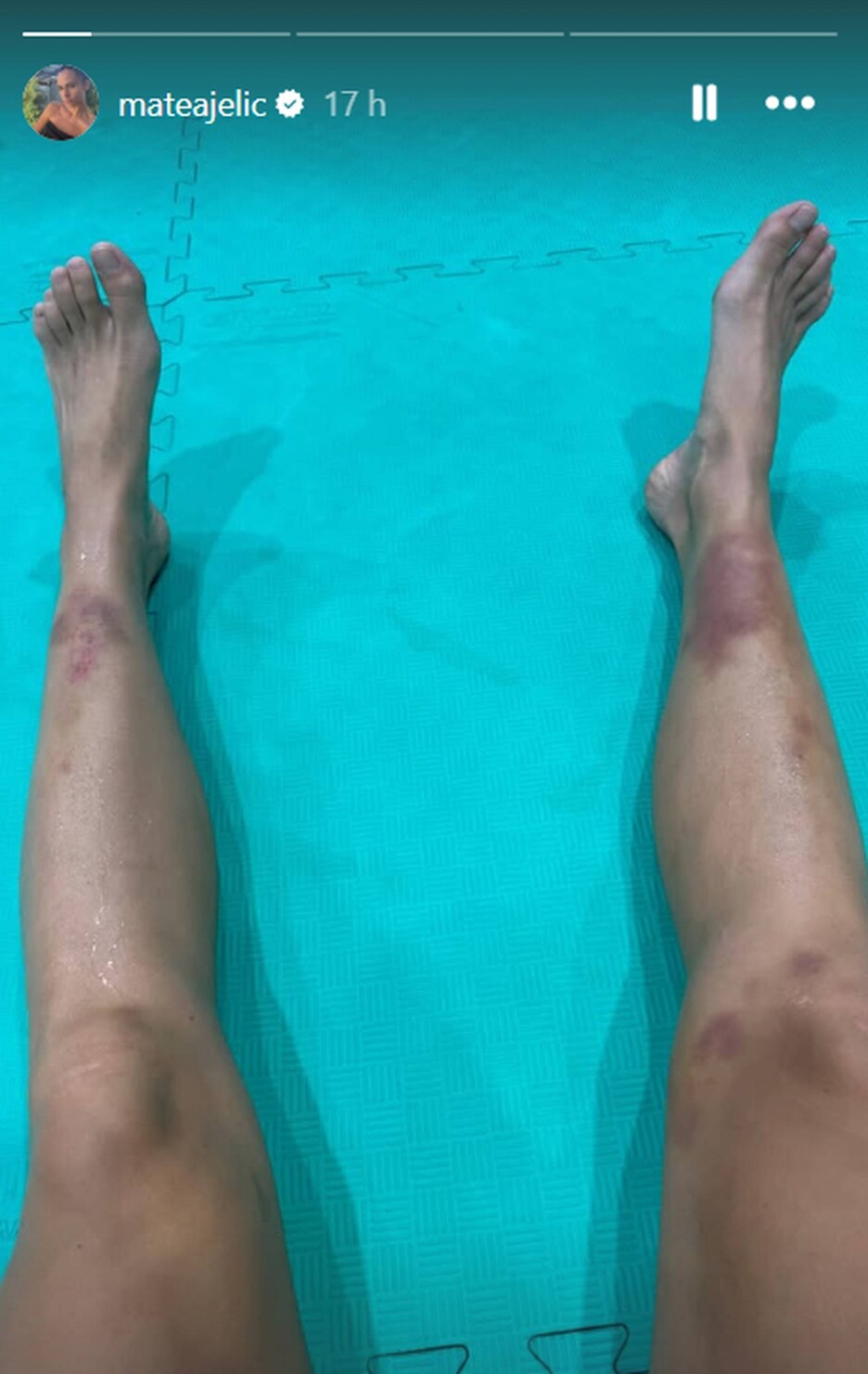Hrvatska sportistkinja šokirala izgledom nogu (Foto: Instagram)