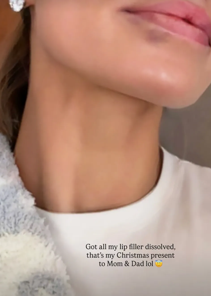 Brooks Nader pokazuje rezultate svojih usana nakon uklanjanja filera (Foto: Screenshot/ Instagram)