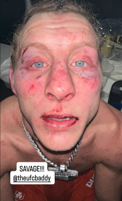 Pimblettovo lice je uništeno (Foto: Instagram)