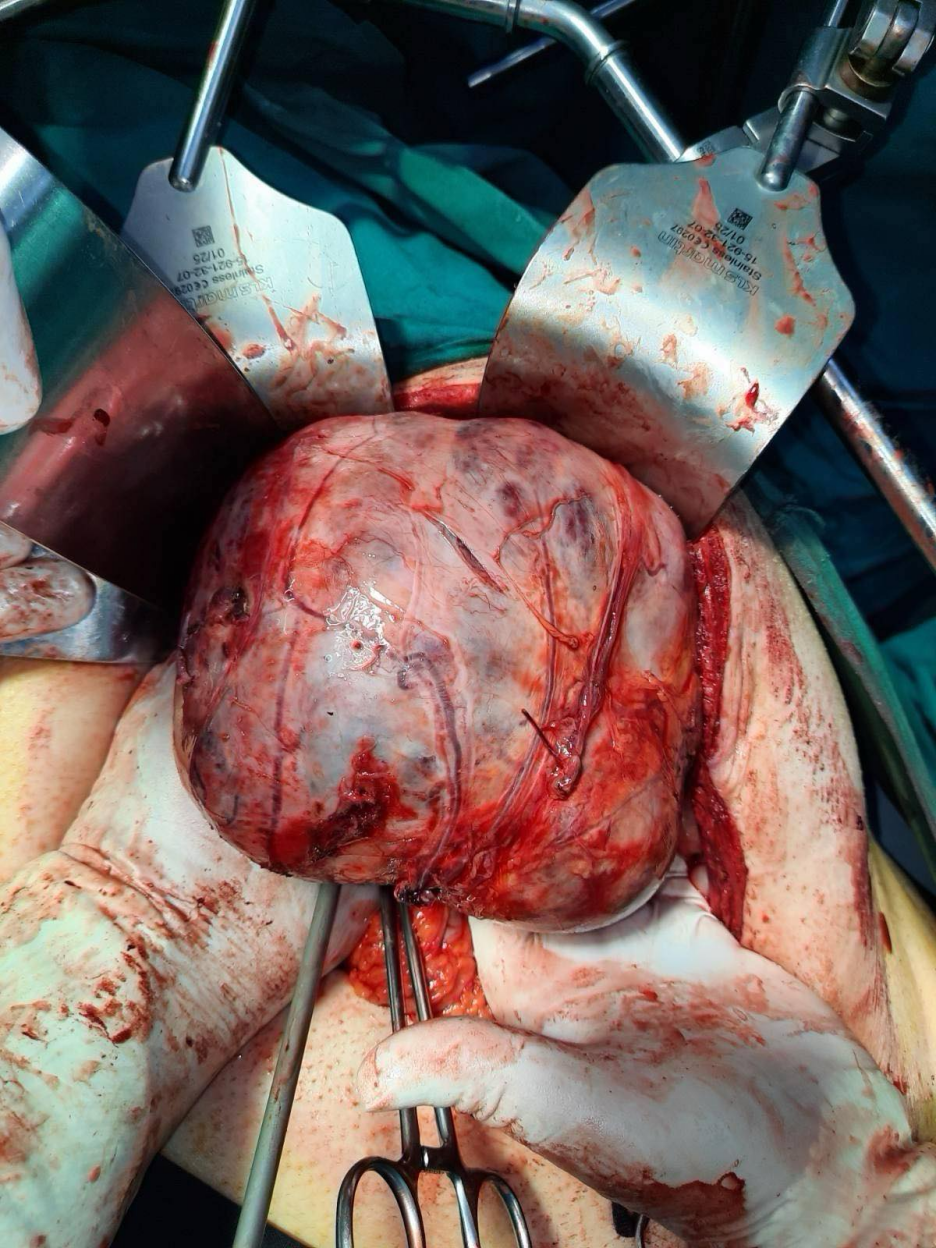 Tumor koji je izvađen iz tijela pacijenta (Foto: Kantonalna bolnica Bihać)