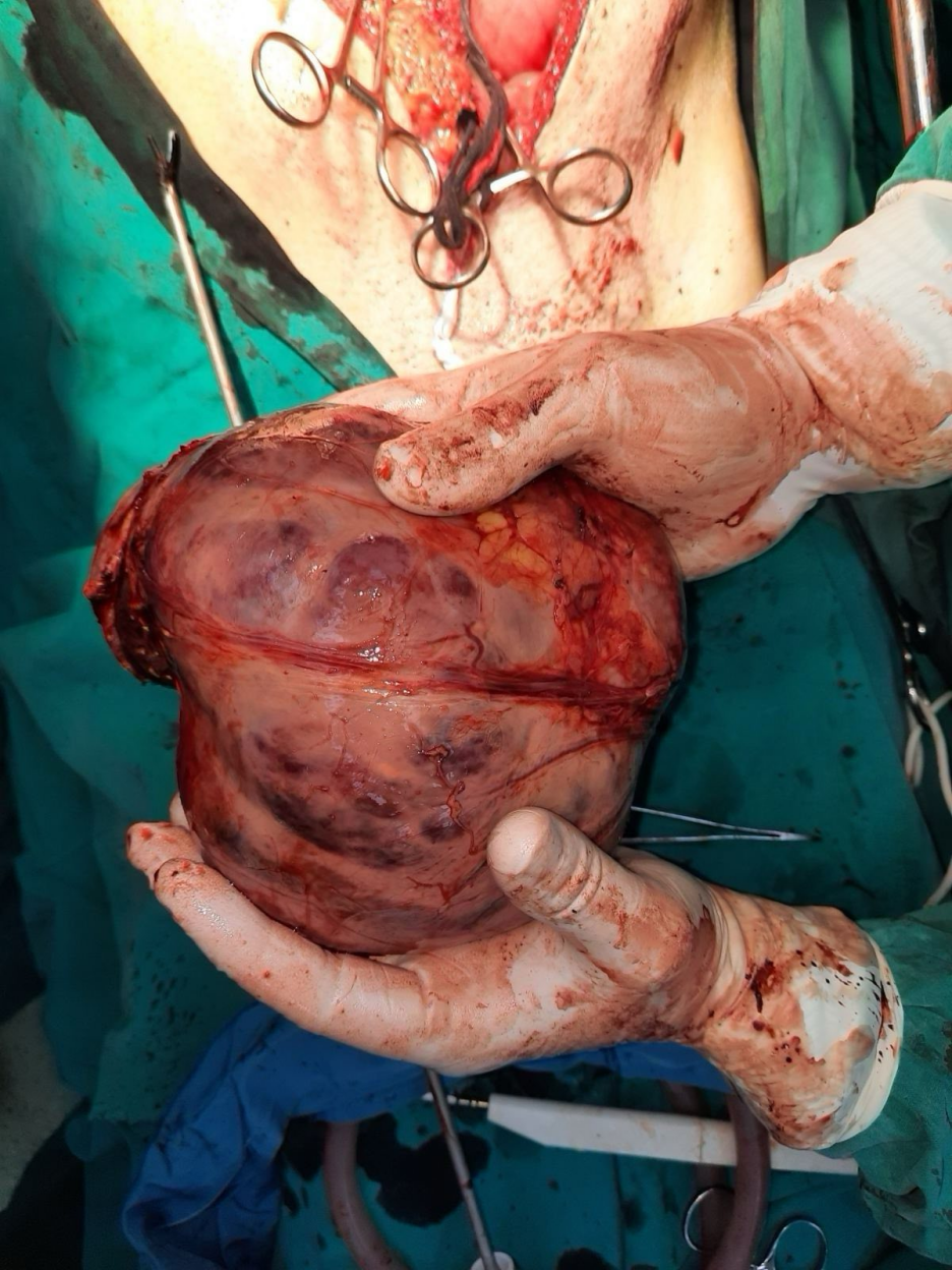 Tumor koji je izvađen iz tijela pacijenta (Foto: Kantonalna bolnica Bihać)