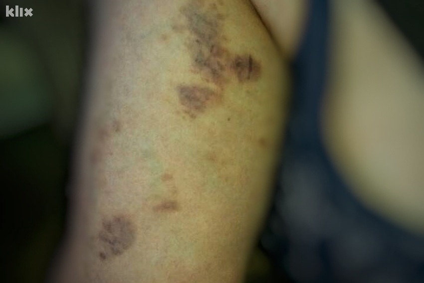 Povrede na tijelu žene nakon privođenja (Foto: Klix.ba)