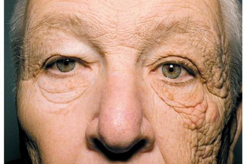 Fotografija vozača kamiona pokazuje kakvu štetu licu nanosi izloženost suncu