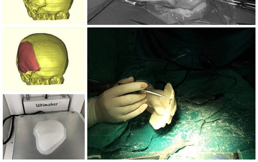 3D prikaz i završni dio koštanog dijela glave (Foto: Kantonalna bolnica Zenica)