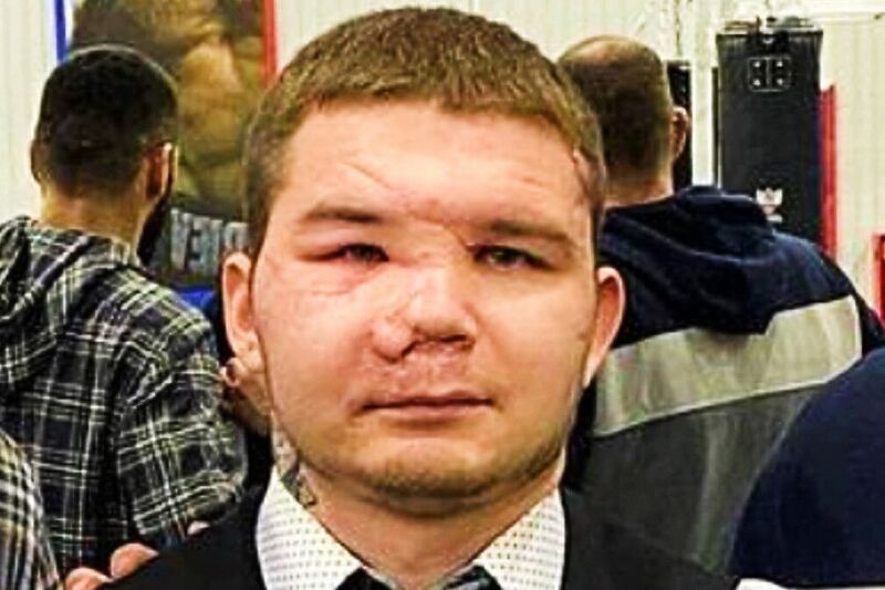 Ruskom bokseru će biti rekonstruisano lice poslije napada medvjeda kojeg je ubio nožem