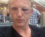 Dirk Kuyt neprepoznatljiv sa pet šavova i zatvorenim okom