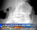 Žalila se na bolove, ljekari otkrili fetus star 44 godine u njenoj utrobi