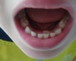 U FBiH uskoro mjere poboljšanja oralnog zdravlja stanovništva, posebno djece