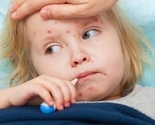 Epidemija malih boginja u Sarajevu: Prijavljeno 56 oboljelih, roditelji u panici
