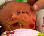 U Australiji rođena beba s dva lica