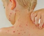 Epidemija morbila traje skoro godinu dana, necijepljenje glavni razlog obolijevanja