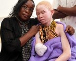 Tanzanija: Albino djecu love kao životinje, prodaju njihove dijelove tijela za sreću