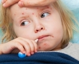 Putnici upozoreni na epidemiju ospica u BiH, posebno u Bugojnu, Fojnici i Travniku