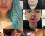 Bizarni trend povećanja usana: Djevojke žele da budu kao Kylie Jenner