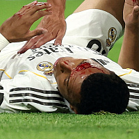 Povreda za koju Real nije dobio penal: Pogledajte kakvu je fotografiju objavio Mbappe