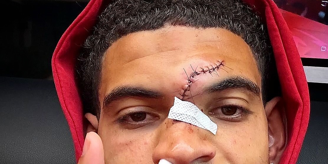 Gibbs-White pokazao unakaženo lice nakon stravičnog sudara, zaradio je šavove od čela do nosa