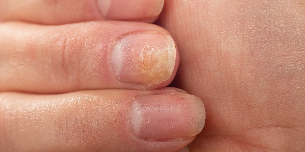 Kako prepoznati simptome psorijaze noktiju i na koji način ublažiti tegobe