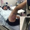 Biciklisti eksplodirao iPhone u stražnjem džepu, zadobio opekotine trećeg stepena