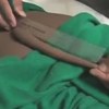 Tinejdžeru iz Indije odstranjen rep od 20 centimetara