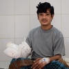 "Čovjek drvo" iz Bangladeša pun nade nakon 16 operacija