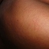 Oboljeli od morbila u FBiH su pojedinačni slučajevi koji nisu epidemiološki povezani