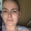 Djevojka koja se bori s rakom objavljuje fotografije prije i poslije kao znak upozorenja