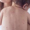 Brzina širenja epidemije morbila iz Istočnog Sarajeva zavisi od stepena kolektivnog imuniteta