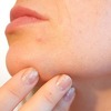 U FBiH nema epidemije šuge ili svraba, ljeti povećana opasnost od mišje groznice